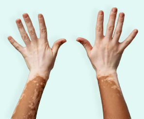 Vitiligo: Understanding the Condition and Addressing Social Stigma