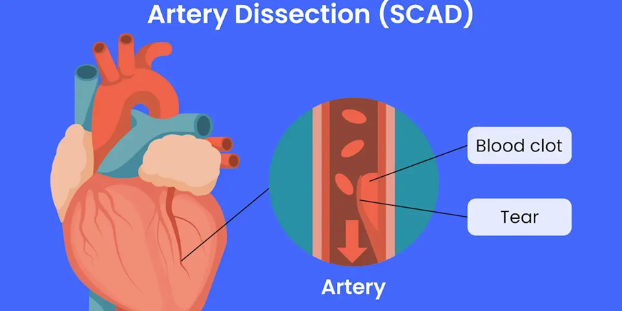 What is Spontaneous Coronary Artery Dissection (SCAD)