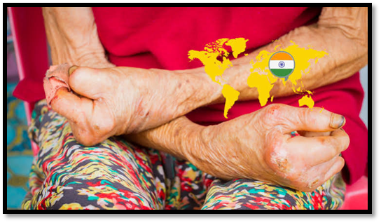 Breaking the Chain of Leprosy Transmission in India